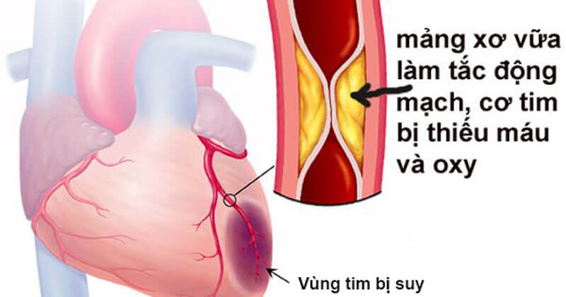 Ảnh 3 của Coronary Artery Disease